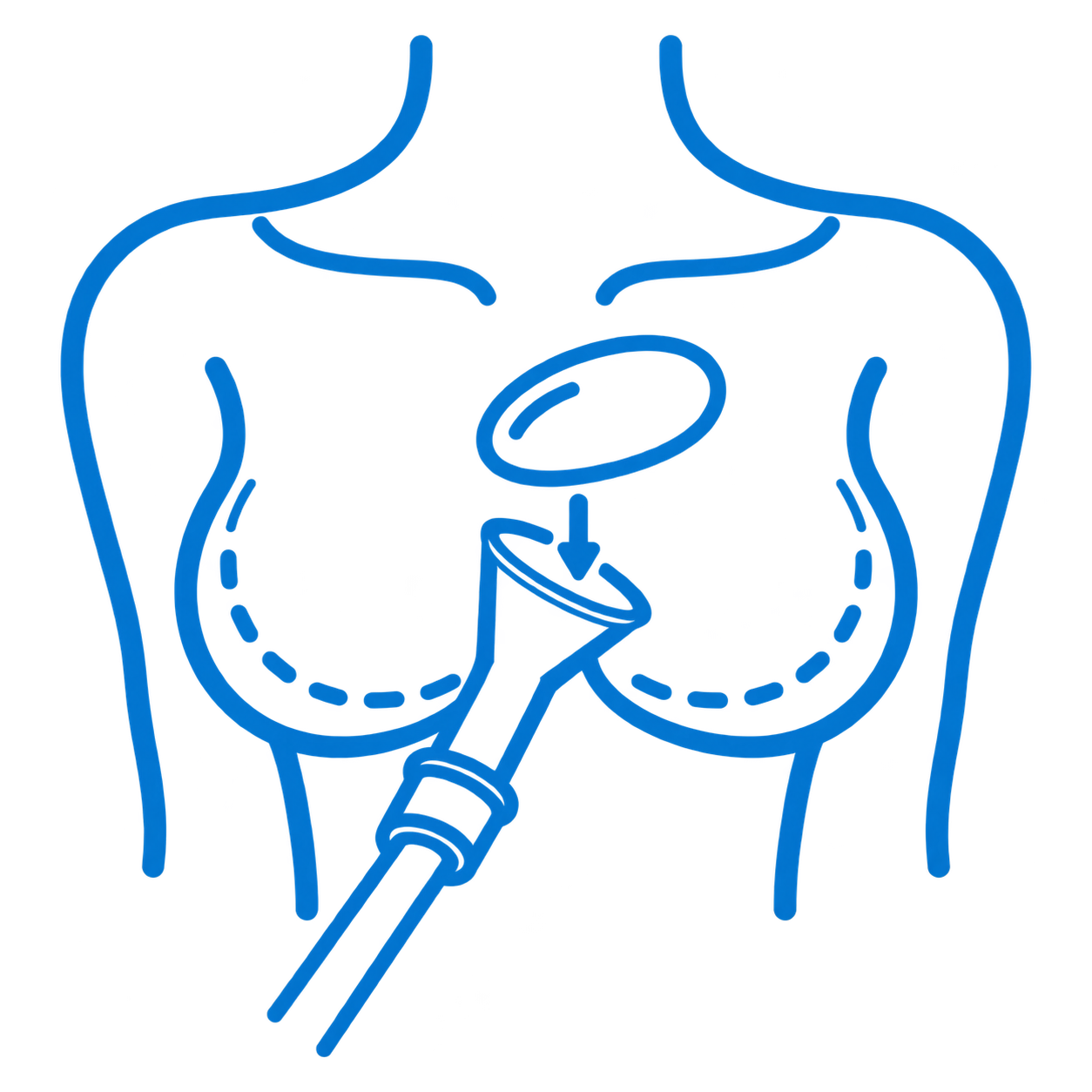 Aumento mamario con implantes
