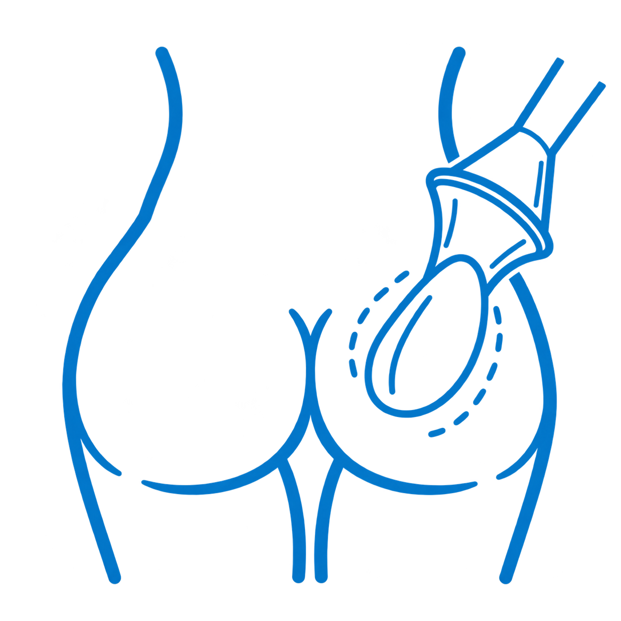 Colocación de implantes glúteos