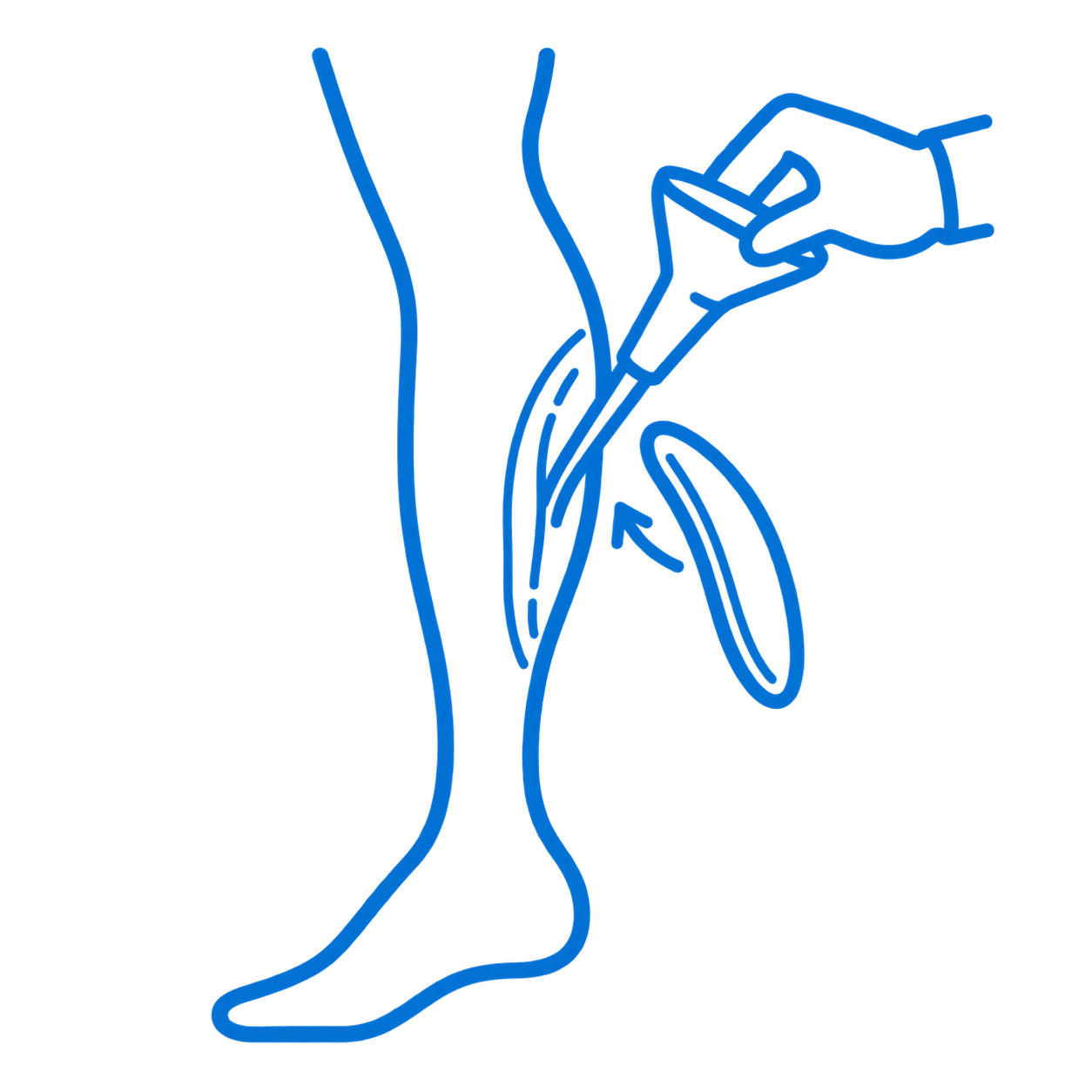 Colocación de implantes de pantorrilla