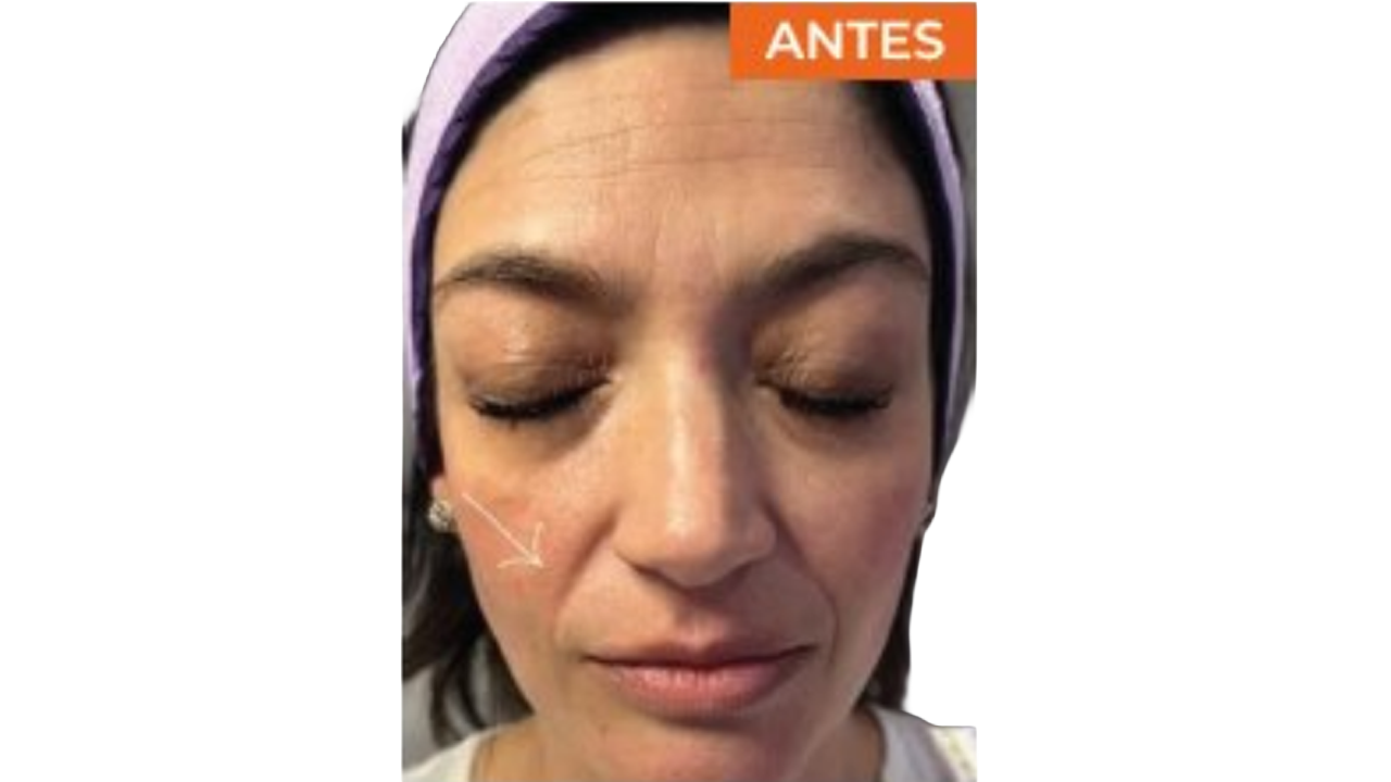 Antes